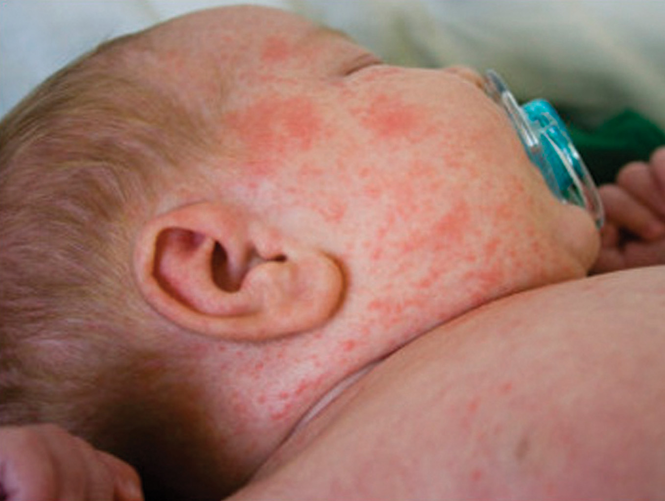 Measles Cases Dramatically Increase in US Due to Anti Vaccine Movement