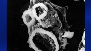 Deadly Brain Eating Amobea Continues Rampage