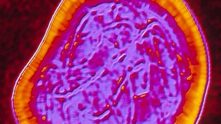 Meales virus under microscope