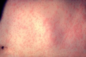 Skin rash from measles