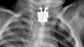 An X-ray reveals a SpongeBob SquarePants pendant lodged in a toddler's throat