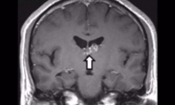 Brain scan of a man who had a tapeworm living in his brain for four years