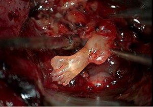 When doctors cut open baby Sam's brain tumor, this foot popped out.