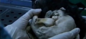 a parasitic twin pulled from the abdomen of a little boy