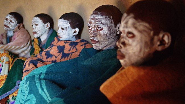 Botched traditional circumcisions are problematic in Africa